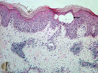 Spongiotic pattern - ekzema Constantly changing histology - acute Preserved stratum corneum Intercellular edema Spongiotic microvesicules +/- Papilláry edema