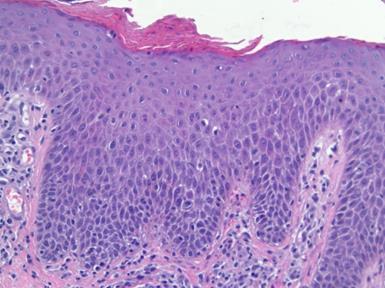 Spongiotic pattern - ekzema Constantly changing histology - chronic compact hyperkeratosis Parakeratosis -/minimal Acanthosis Minimal spongiosis Superficialis