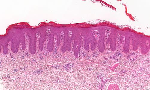 Acanthotic pattern - psoriasis Parakeratosis Regular acanthosis Neutrophils in stratum corneumban/epidermis Loss of