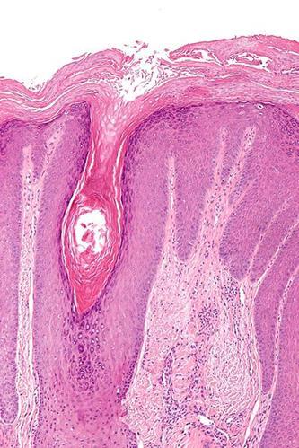 Acanthotic pattern - lichen simplex chronicus (LSC) compact hyperkeratosis Parakeratosis -/focal