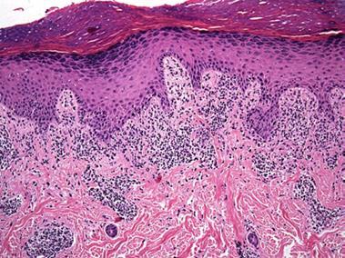 lichenoid pattern - lichen planus Inflammatory Dermatopathology - Billings Compakt hyperkeratosis No parakeratosis