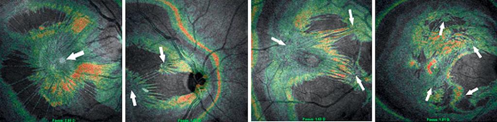 Full-thickness vitreo-macular adhesion may also be important in patients with age-related macular degeneration (AMD).
