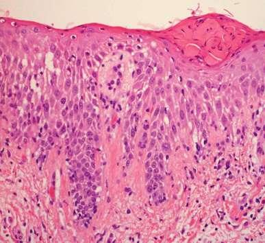 Spongiosis: pathogenesis Permeation of the epidermis and dermis by inflammatory cells and fluid (plasma
