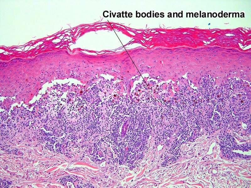 civatte bodies and pigmentary