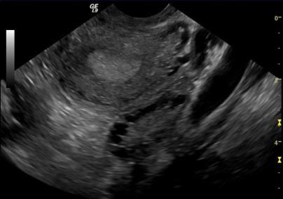 Diagnosis of Polycystic Ovarian Morphology Use transvaginal ultrasound o Follicle # per ovary > 18 &/or ovarian volume > 10ml if using new technology (>8MHz transducer) o Follicle # per ovary > 12