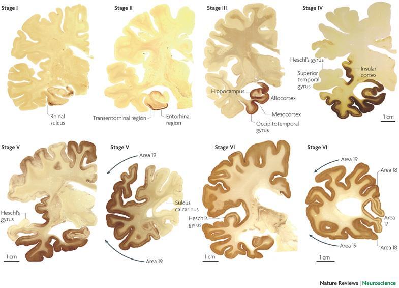 Vascular dementia (multiple strokes) Frontotemporal dementia (FTD), Pick s disease Alcoholic dementia HIV associated neurocognitive disorder (HAND) Chronic traumatic encephalopathy (CTE), dementia