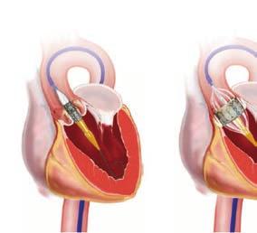 TRANSCATHETER AORTIC VALVE REPLACEMENT (TAVR) PROCEDURE HIGHLIGHTS OF THE VALVE CLINIC Our valve team has extensive TAVR