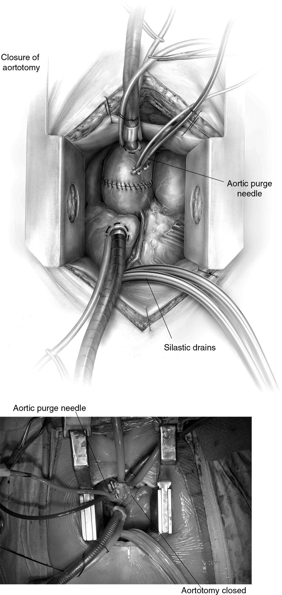 332 P.S. Shekar Figure 11 After placement of an appropriate deairing needle in the ascending aorta, the patient is placed in steep Trendelenburg position and the aortic cross-clamp is released.
