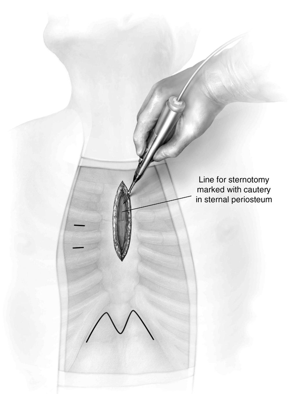 Minimal access aortic valve surgery 323 Figure 2 The skin