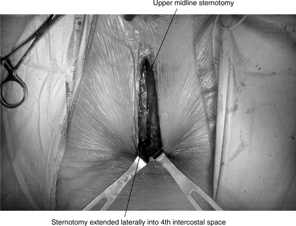 Minimal access aortic valve surgery 325 Figure 4