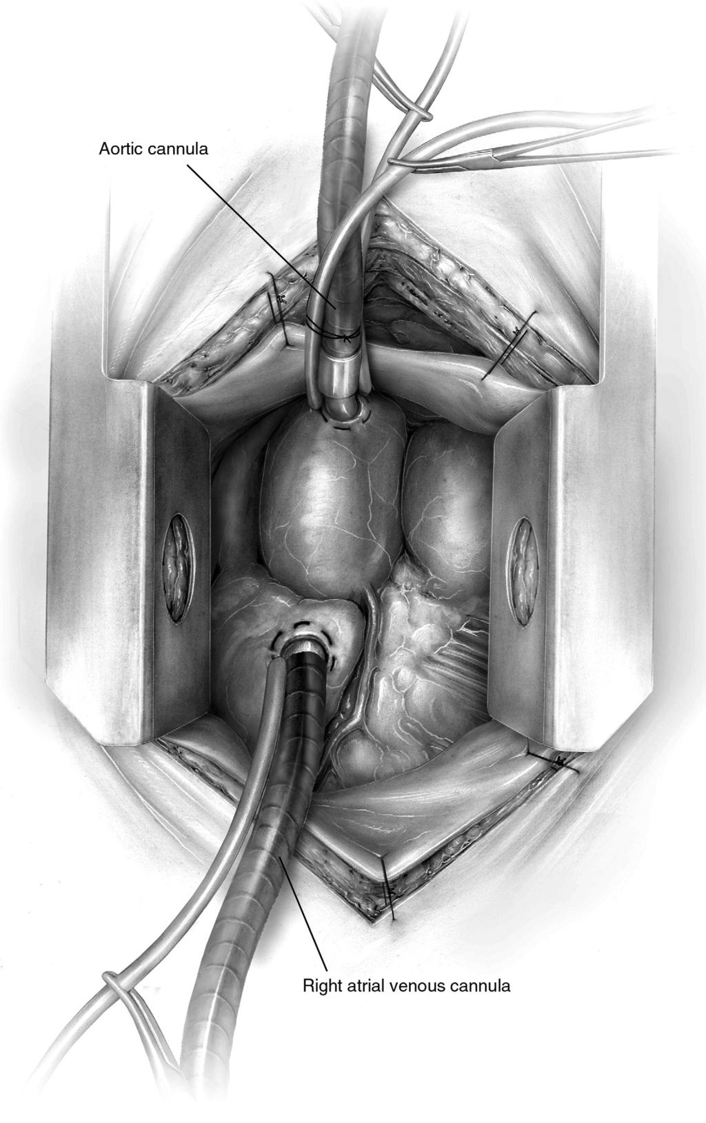 328 P.S. Shekar Figure 7 Cannulation is completed in the standard fashion using a standard aortic perfuser and a three-stage right atrial venous cannula.