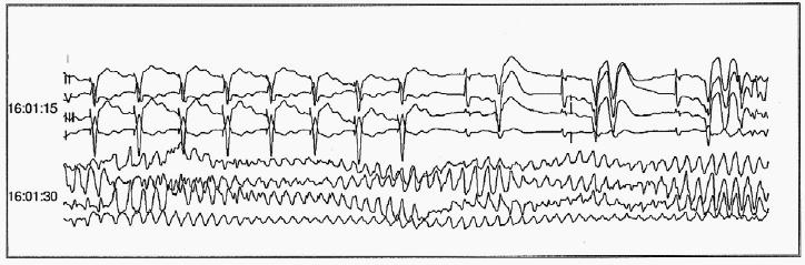 Problems in pacing modes avoiding RV pacing