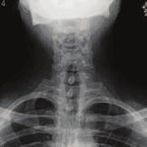 Spinal procedures offered at Greensboro Imaging: Discograms Epidural injections Kyphoplasty Myelograms Nerve and root blocks Vertebroplasty As many as 80% of patients that undergo vertebroplasty, a