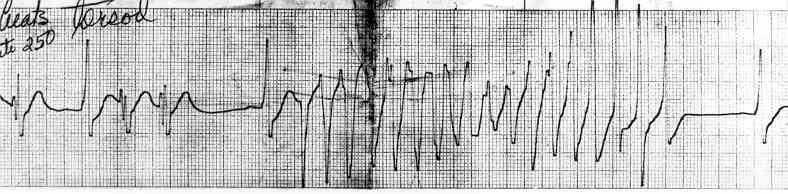 Long QT interval: Pathophysiology of ventricular tachycardia Early After-Depolarizations: Cellular hypoxia Catecholamines Other