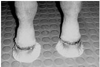 Other Angular Limb Deformities: Treatment Conservative: - Mild cases (5-10 ) or early in physeal growth Rest, trimming, shoes Surgery: - Moderate to severe cases or at end of physeal growth