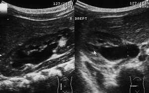 Material şi metodă. Vom prezenta cazul unui pacient de 2 ani şi 4 luni diagnosticat intrauterin cu hidronefroză dreaptă.