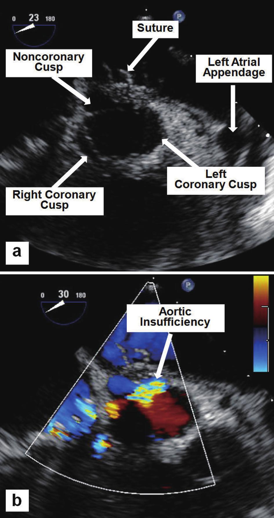 Mid-esophageal TEE images showing a suture tethering the non-coronary cusp (a), and the resulting moderate-to-severe AI by color flow Doppler (b). surgery.