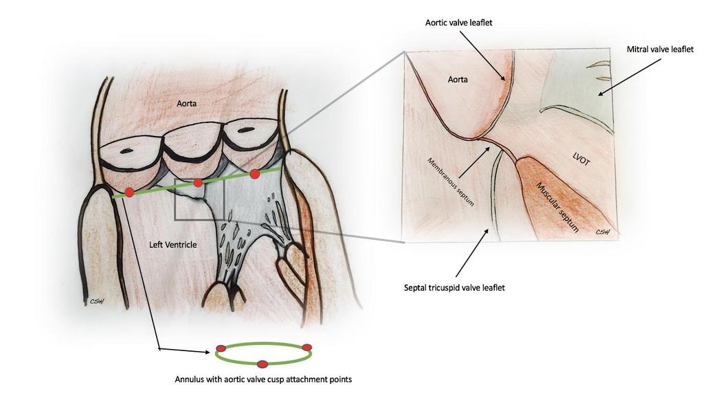 Figure 1: The aortic valve annulus is a virtual ring represented by a line drawn through the nadirs of the aortic valve