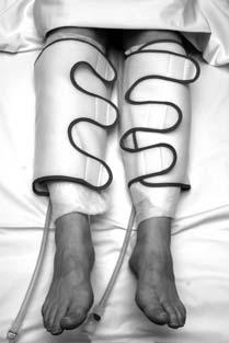 Devices that can improve blood flow Anti-embolism stockings These special stockings prevent blood from collecting in the veins of your legs.