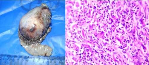 Site Number Diagnosis Stomach 4 Stomach GIST (1) Mature teratoma (3) Jejunum 3 DLBCL (1) Yolk sac tumor (1) Ileocaecal 11 Burkitt Lymphoma (3)