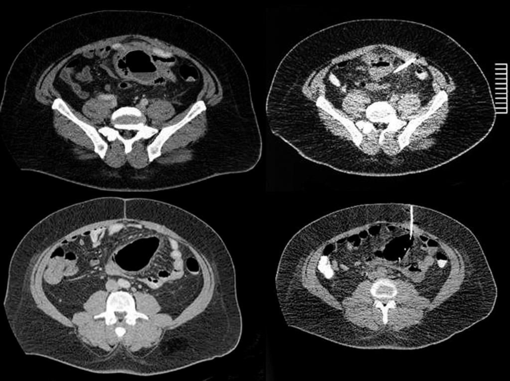 A B C D Figure 5 Sigmoid diverticulitis complicated by pericolic abscesses (A and C, arrows) requiring treatment by placement of two separate CT-guided percutaneous drains (B and D).