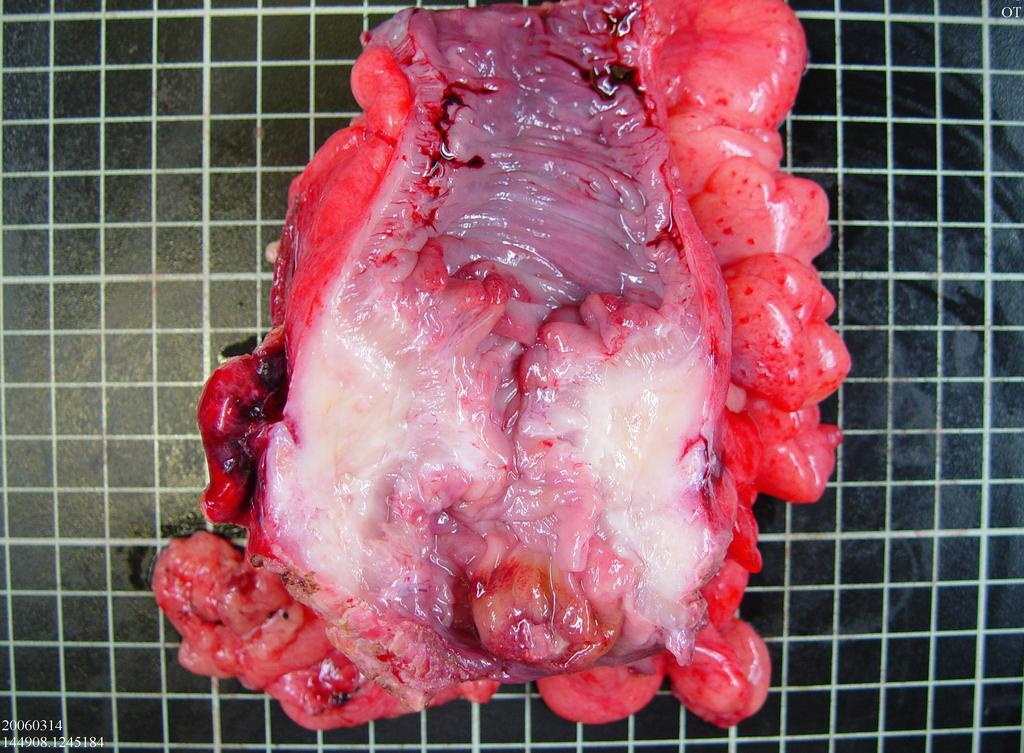 st 1 operation on 2006/3/9 Procedure: descending colon segmentectomy and primary anastomosis Op finding: stricture of descending colon, intestinal wall