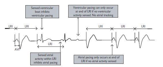 DDI Non-P synchronous pacing with dual chamber sensing Useful fall