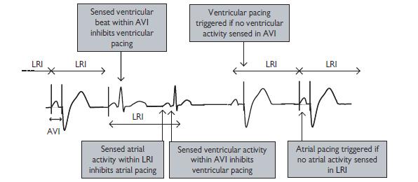 DDD Physiological pacing with A -V synchrony