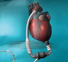 Illustration of Implanted HeartWare Ventricular Assist System For patients who are not able to receive a heart transplant, Baylor Dallas can offer improved quality of life through implantation of a
