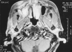 148 Y. L. Huang, C. F. Tseng, L. K. Yang, and C. H. Tsai Fig. 3. Eighteen months after therapy, MRI of the neck and nasopharynx revealed neither local recurrence nor distant metastasis.