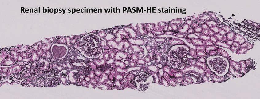 3. Observation of renal biopsy PASM-stained specimens, which are commonly used in renal biopsy diagnosis, can be directly observed by LV- SEM 3).