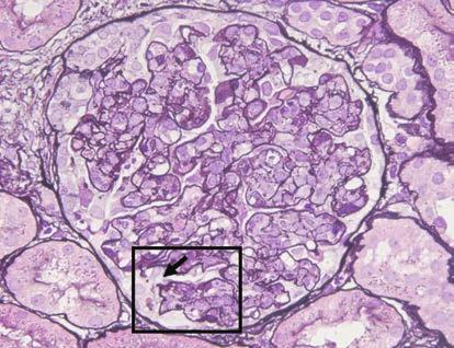Remarkably effective for study of lesions in renal glomerular basement membrane Hemocyte leakage PASM-HE (enlarged image of 600 magnification) (LM maximum magnification 600, resolution 200 nm, 2D
