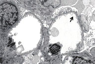 6 LV-SEM images of glomeruli in thin basement membrane disease