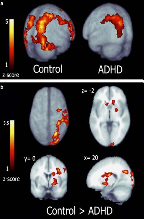 Functional Imaging Studies Functional Magnetic Resonance Imaging (fmri) findings: Greater activation in the