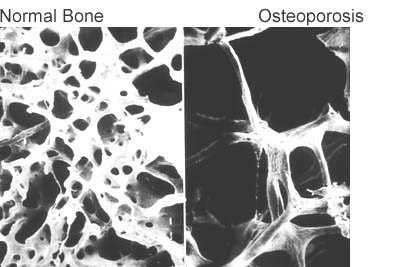 InfoSheet Osteoporosis Da