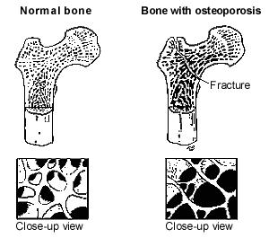 Osteoporosis Page 2 WHAT IS OSTEOPOROSIS? Osteoporosis means porous bone. In this scenario, there is too much empty space, and not enough new bone.