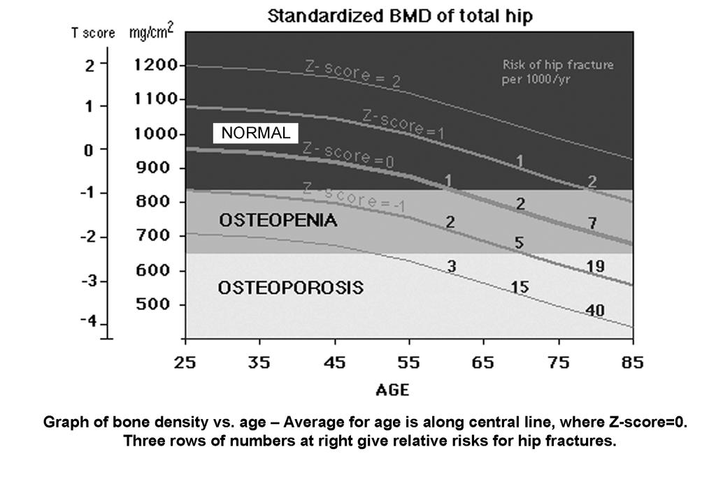 Osteoporosis Page 4 absorptiometry). A DEXA scan is a study similar to taking an x-ray using a machine that measures bone density.