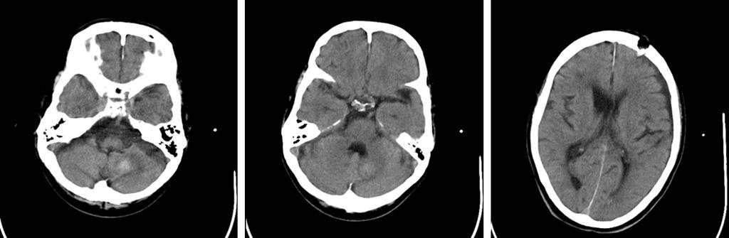 Figure 1. Pre operative CT scan. Representative pre-operative CT scan of a patient in it showing a posterior fossa haemorrhage with associated hydrocephalus and blood in the ventricles. Figure 2.