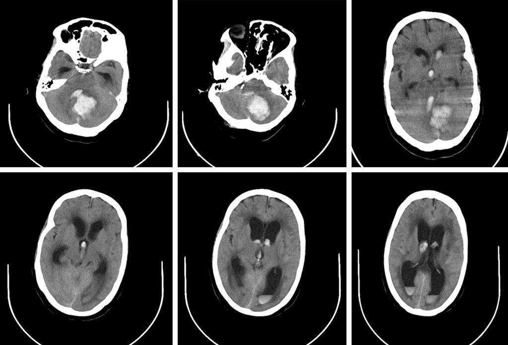 Figure 3. Pre operative CT scan. Representative pre-operative CT scan of a patient in it. showing a posterior fossa haemorrhage with associated hydrocephalus and blood in the ventricles. Figure 4.