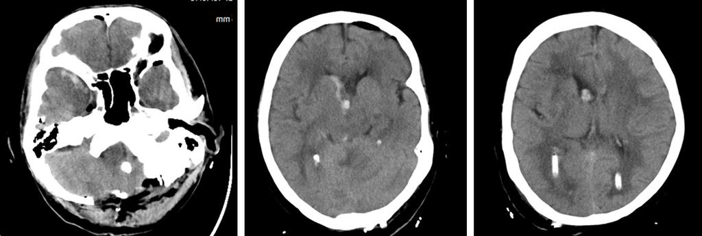 Scan done two days after surgery showing resolving hydrocephalus and a significant reduction in the intra- ventricular blood and the absence of posterior fossa Haemorrhage.