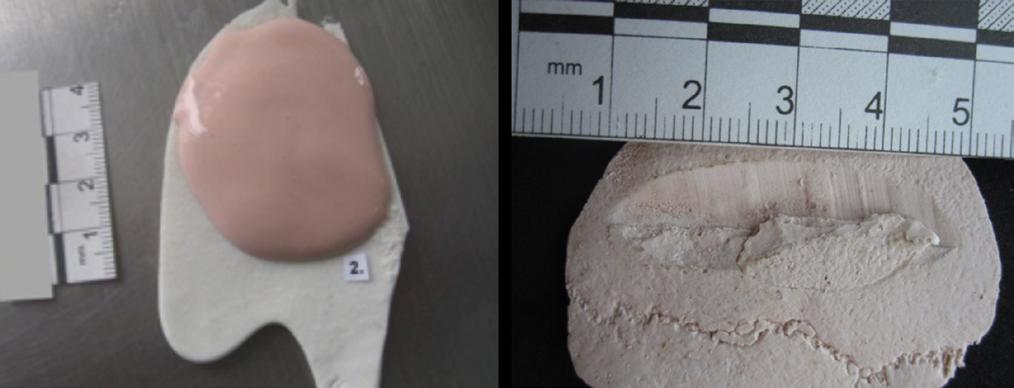 use of dental impression materials in the analysis of tool marks to identify causal elements 1.7 Fig 3. Plaster casting of the tool mark on the cranial surfac tions of the plaster manufacturer.