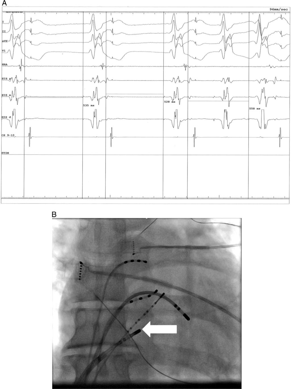 Rivner et al Cryoablation of Dual Atrioventricular Nodal Nonreentrant Tachycardia 67 Figure 3 A: Spontaneously observed intracardiac electrograms during electrophysiology study demonstrating