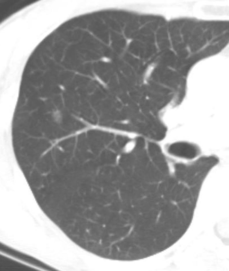 Lee et al. that completely obscured the lung parenchyma. A lesion was classified as PNGGO if none of the lung parenchyma within it was totally obscured.