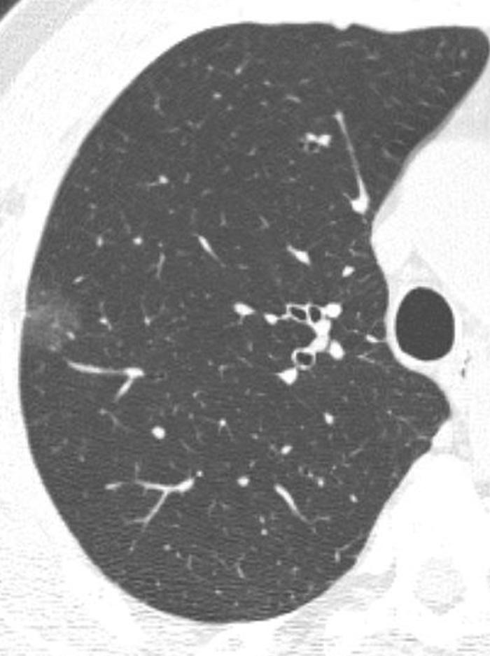 Size Change versus Pathology in Nodular Ground-Glass Opacity Lung Lesions rate of malignancy and the rate of adenocarcinoma according to the grade of solid portion were also evaluated.