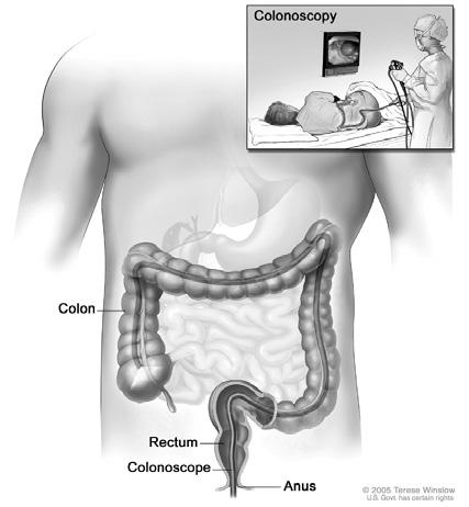 How the bowel is examined by colonoscopy What can I do to reduce my risk? A balanced diet, limited red meat with fresh fruit and vegetables and plenty of fibre is advisable.