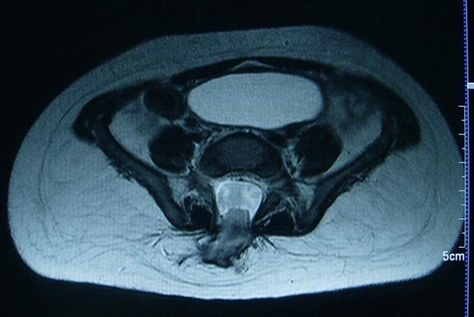 Figure 1: Axial CT image showing anterior sacral meningocele. Dorsal dermal sinus occurred in only one case accounting for 1.