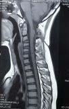 image3: MRI of Cervical region sagittal view in T1Wi image shows posterior