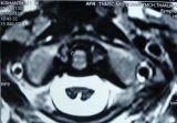 shows no evidence of hydrocephalus image4 T1Wi axial view of cervical cord