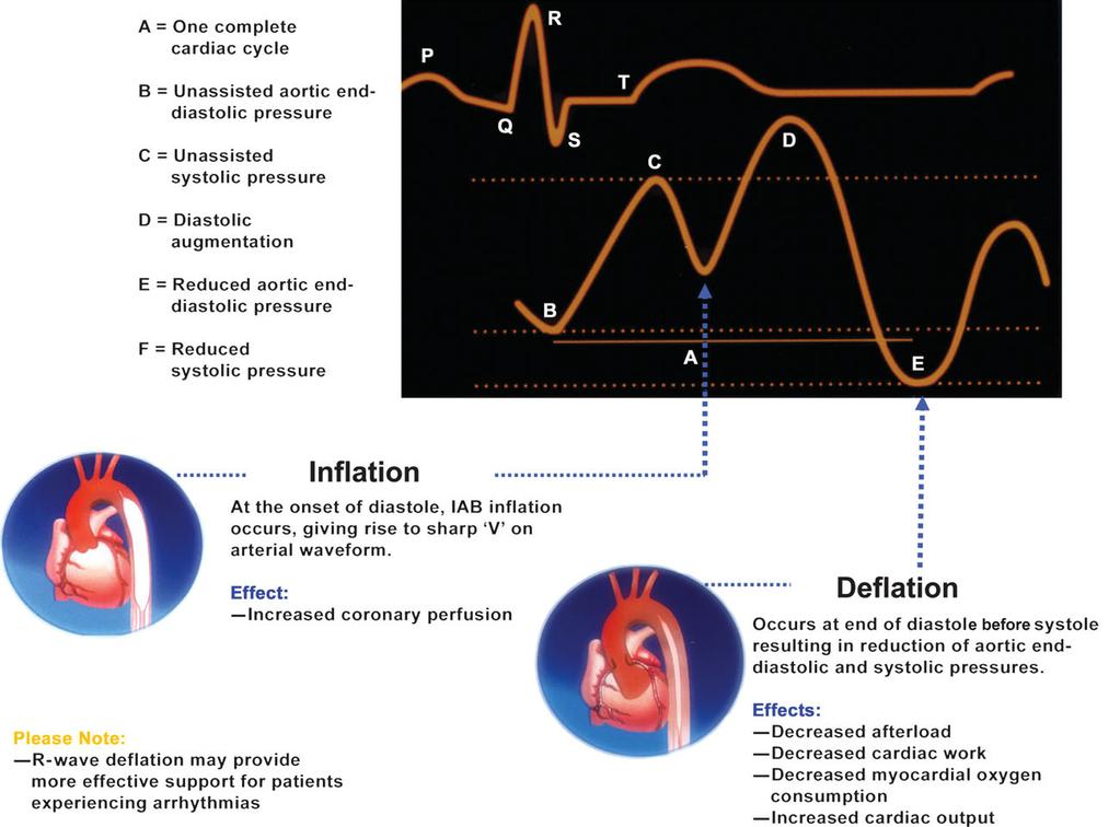 Fig 1 One complete cardiac cycle and the corresponding waveform of the IABP during inflation and deflation. Reproduced with permission from Datascopew.