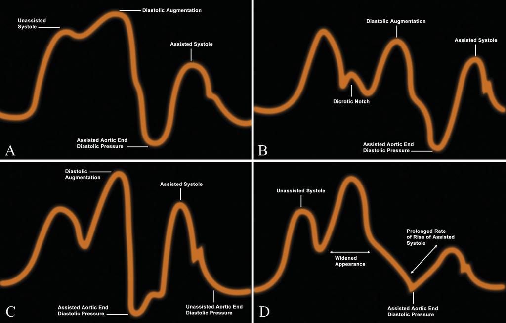 Fig 2 (A) Waveform characteristics: inflation of IAB before dicrotic notch; diastolic augmentation encroaches onto systole, may be unable to distinguish.